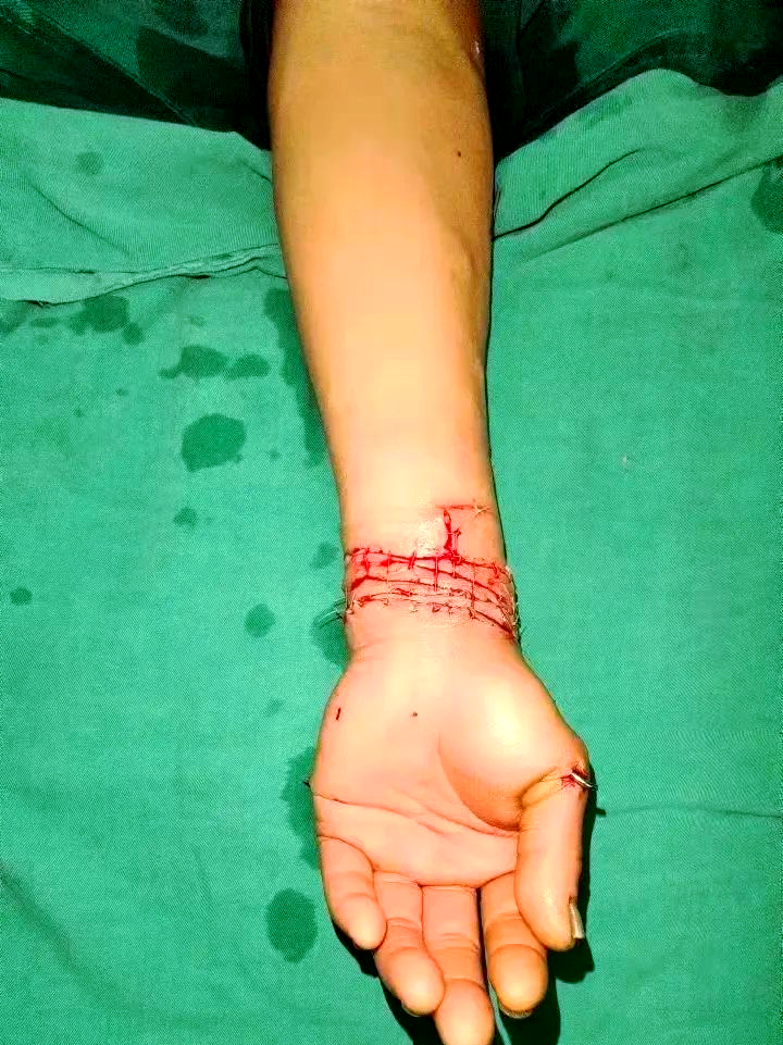 抑郁症患者自残成功保肢:医学团队的奇迹救援