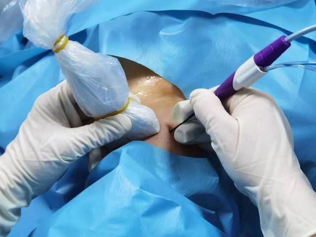 案例分享:甲状腺结节消融手术,其实也没那么可怕