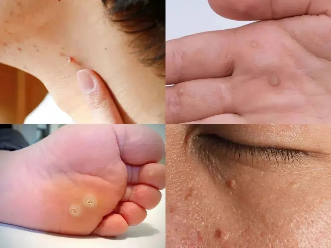 皮肤上这种小凸起,其实是hpv感染,太容易被忽略