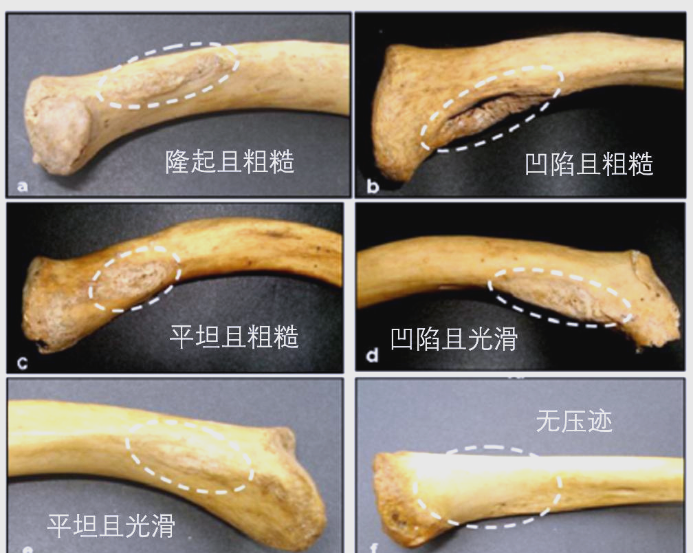解读锁骨菱形窝的影像特征及其诊断挑战
