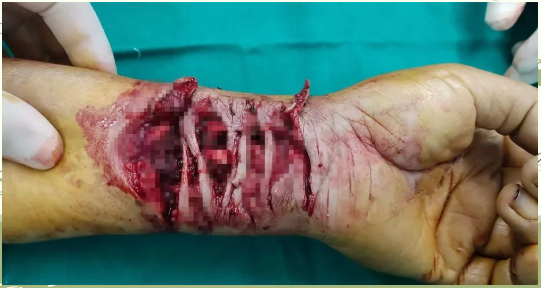 武汉紫荆医院成功救治手腕"百叶窗"状割伤患者