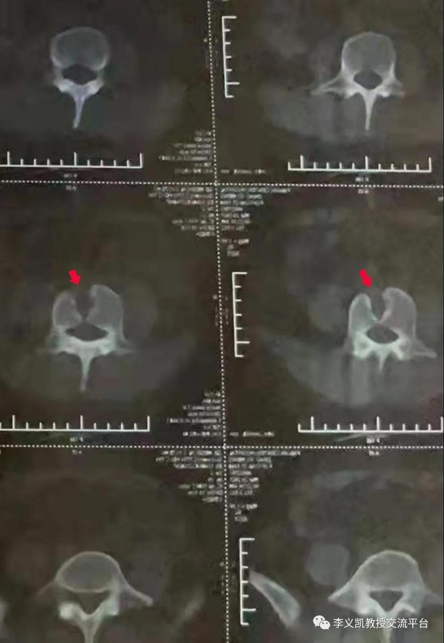 第四腰椎的蝴蝶椎 转发同行照片,本例患者为第四腰椎的蝶形椎,因先天