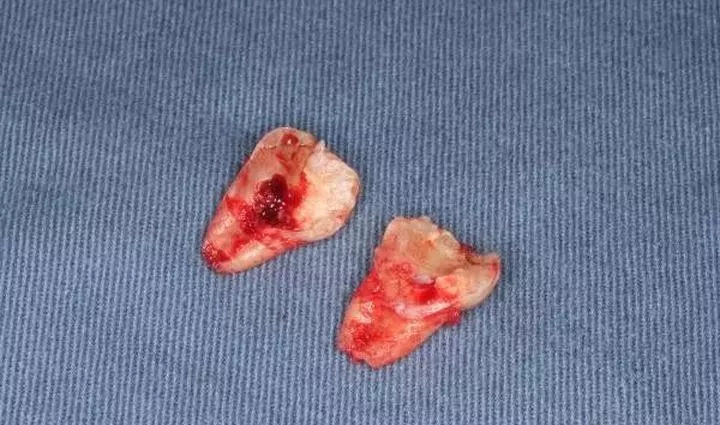 拔个智齿,为什么这么贵?