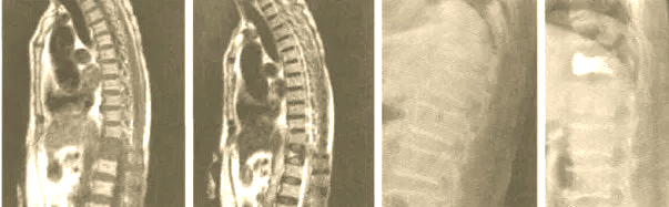 青少年驼背的病因与影像研究:休门氏病的深度解析