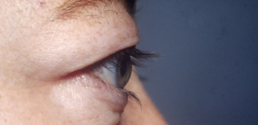 4期试验数据:tepezza改善慢性甲状腺眼病患者的眼球突出