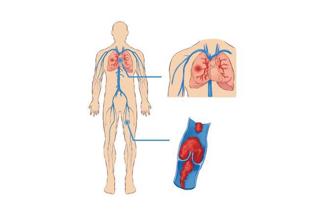 肺栓塞图片 示意图图片