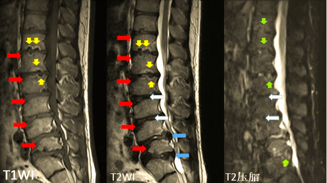青少年驼背的病因与影像研究:休门氏病的深度解析