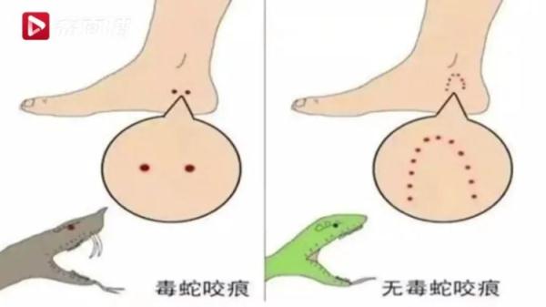 7月一医院收治被蛇咬伤患者60多例!夏季高发!