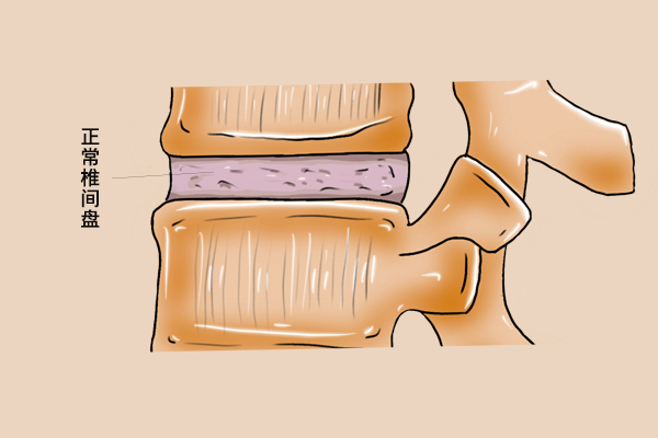 腰椎骨质增生和腰间盘突出的区别在哪里呢?应该如何进行区分?