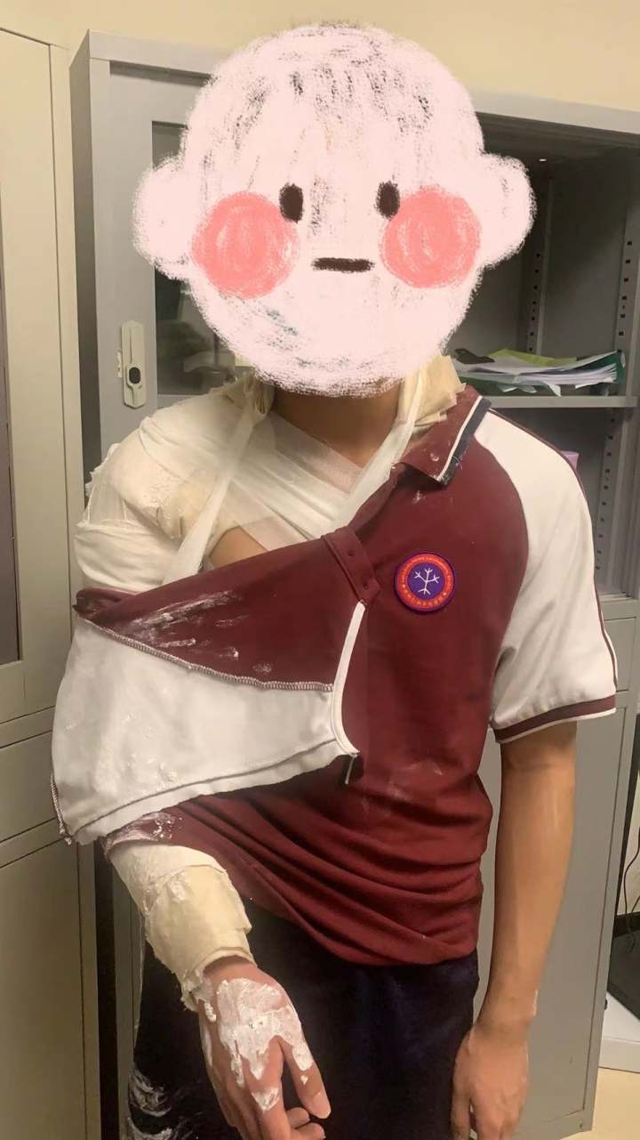 掰手腕掰到骨折!演员张新成最近在录制某综艺节目时意外受伤