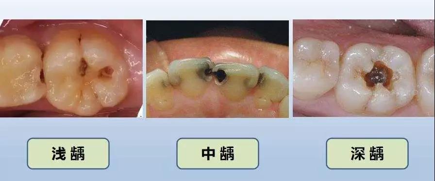 六龄齿龋坏图片