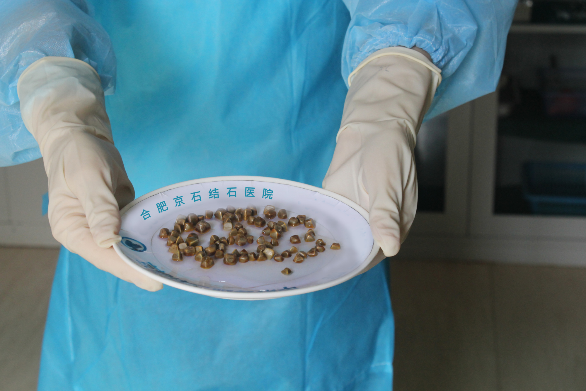 合肥京石结石医院取出惊人的结石量.速看!