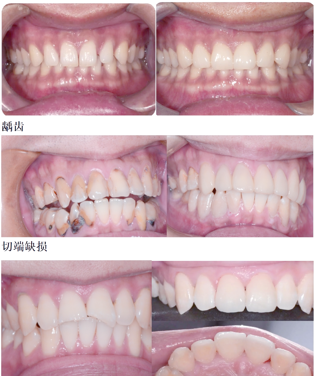 前牙美学修复技术,让你的牙齿焕发新光彩