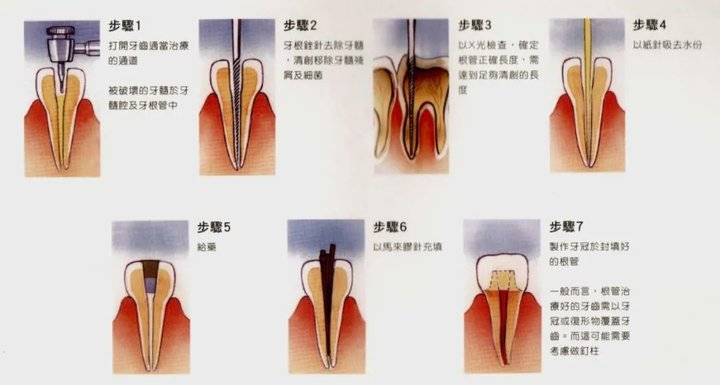 根管治疗就是抽牙神经?德州市中医院专家给你安排的明明白白