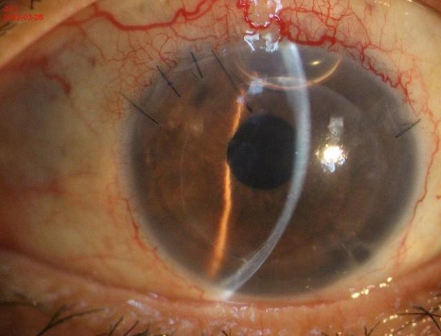 角膜内皮失代偿致视力告急,三个月成功移植角膜重获视力