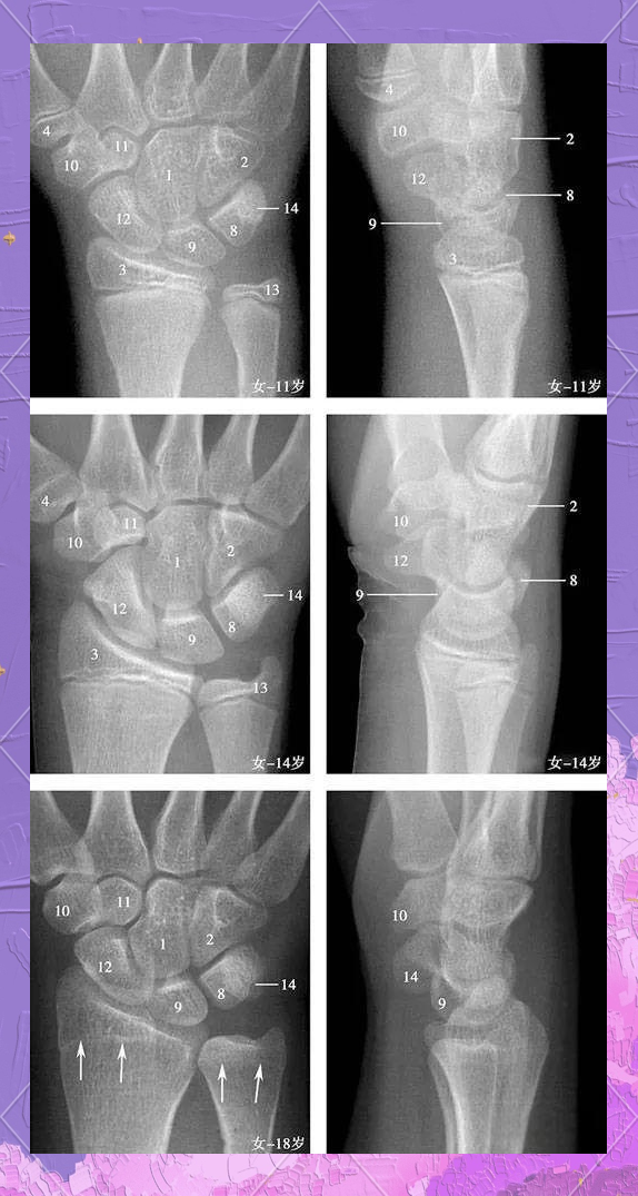 腕关节x线片:成人及生长期的全面解析