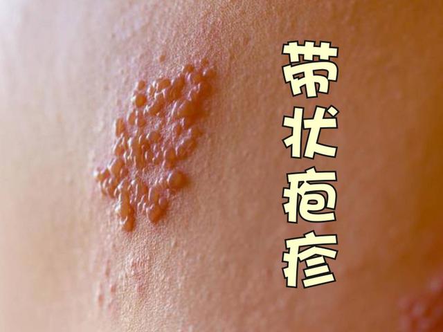 带状疱疹都有什么表现?如何诊治?专家共识带你全面了解