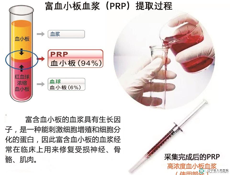 富血小板血浆 冲击波治疗骨折后骨不连