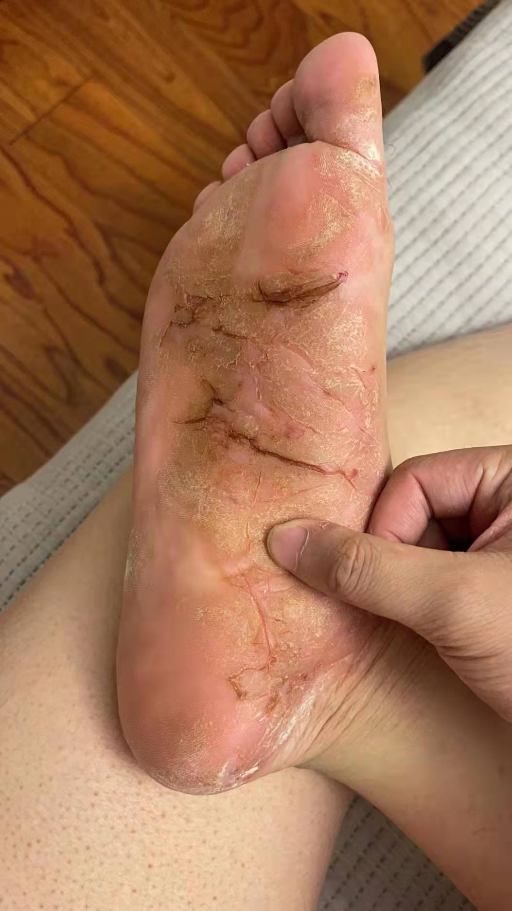 脚部湿疹怎么治疗图片