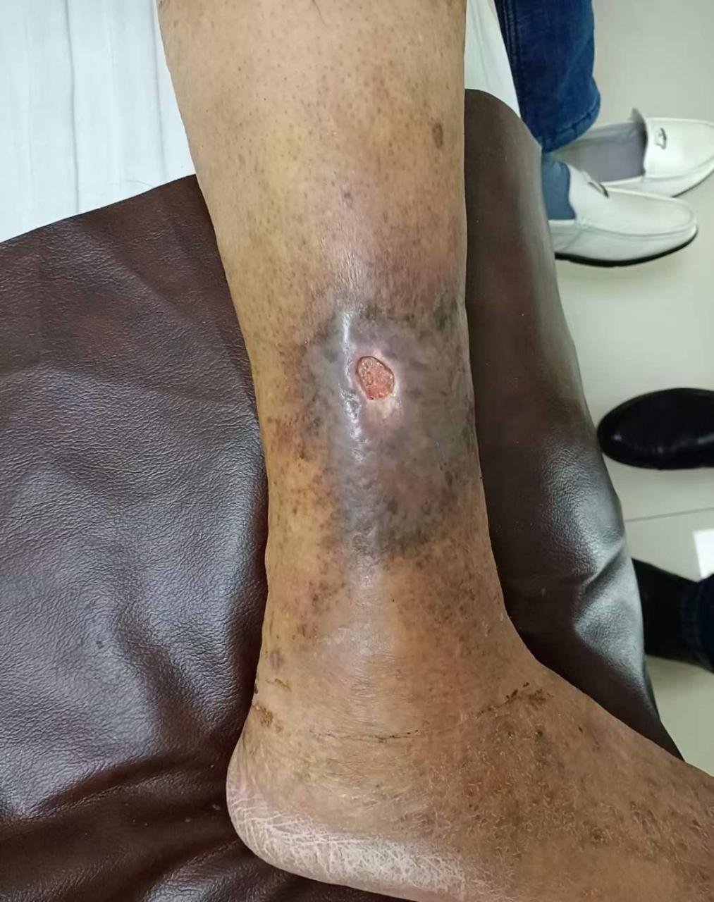 小腿下段皮肤溃疡,这个病为啥难治疗?