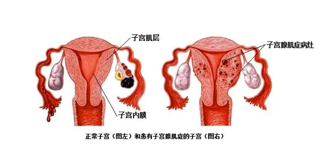 子宫肥大图片图图片