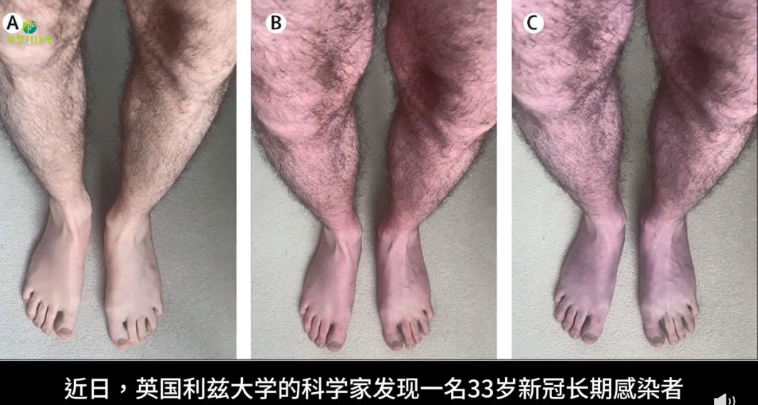 一英国人长期感染新冠导致腿变蓝 一种罕见的现象