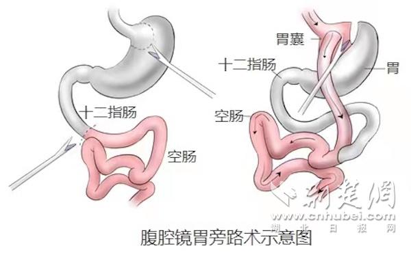 330斤重磅小伙接受减重手术 一月减掉50斤