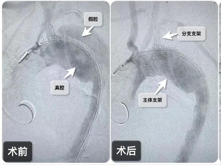 滨州市人民医院介入医学科团队应用castor分支支架成功救治一例胸主动
