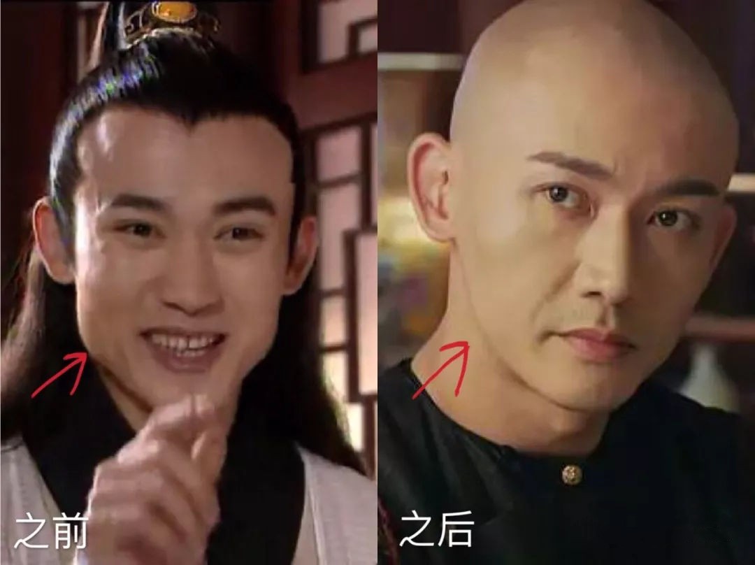 削骨的风险有多大?陈小纭,杨幂,聂远用行动来告诉你真相