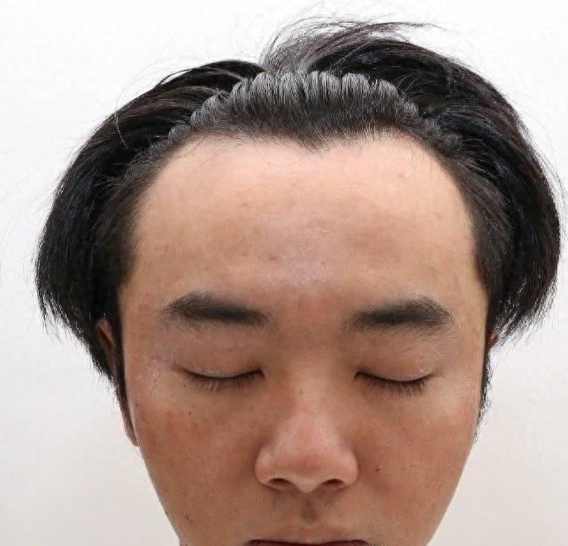 网友晒华晨宇的私人视频,贴出他整容,植发照片,怒骂张碧晨小三