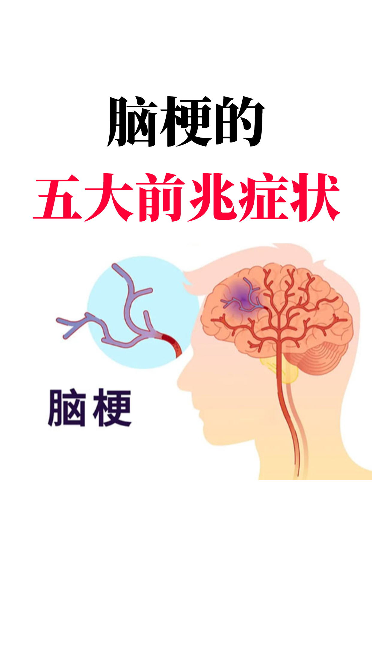 脑梗塞的症状及前兆图片