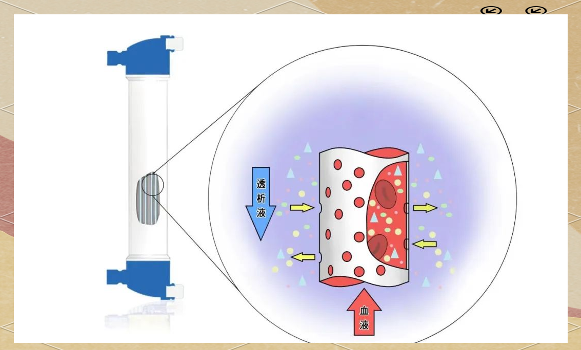 深入了解透析器:血液净化领域的"清洁小时工"