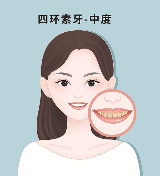 怎样预防四环素牙?教你3个小妙招,搞定四环素牙!