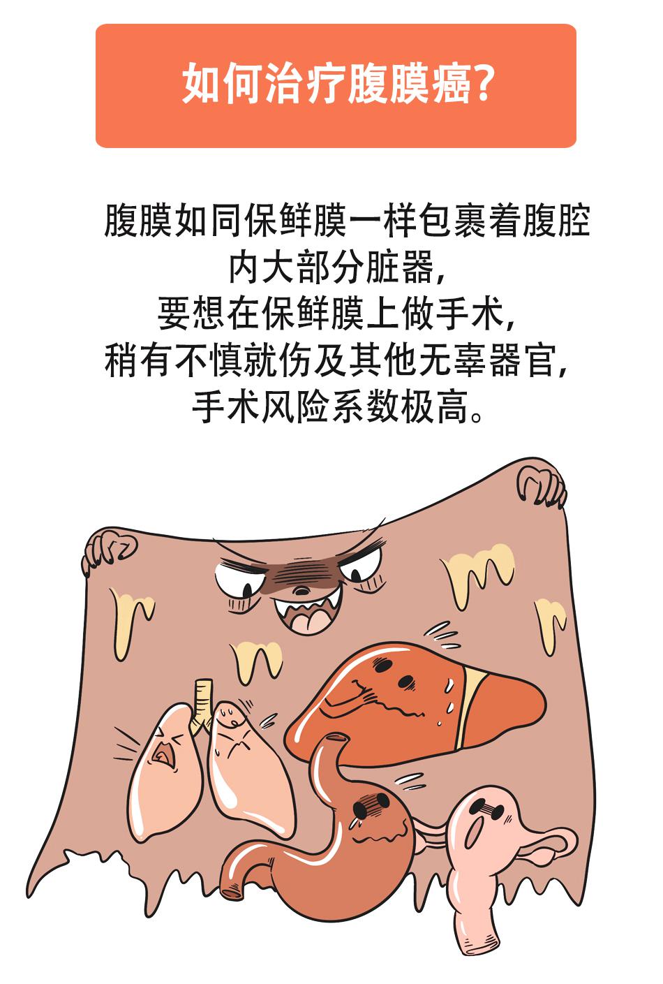 "老大难"腹膜癌能治吗?