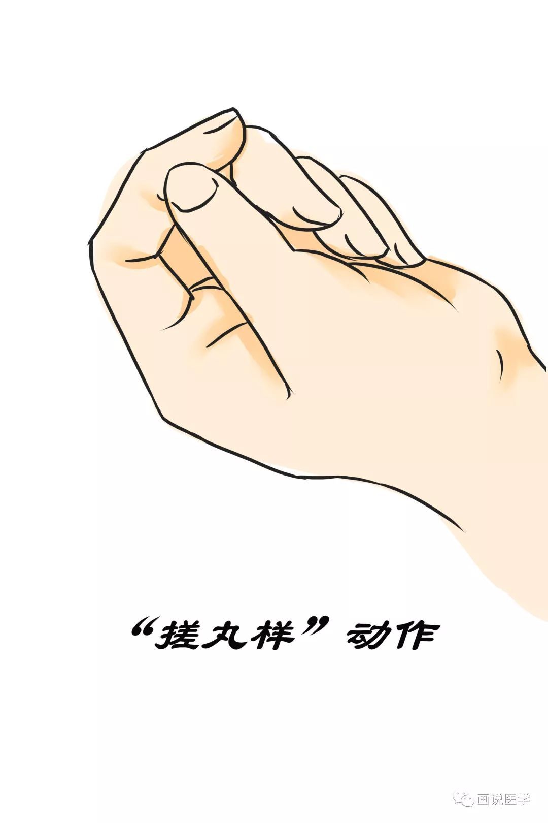 老人的手出现搓丸样姿势并非脑梗,可能是帕金森病