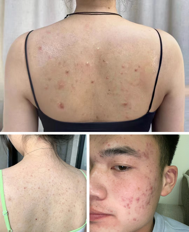 100年国货老牌,液体硫磺皂爆火!"60秒"揪出千万螨虫!全身嫩乎乎!