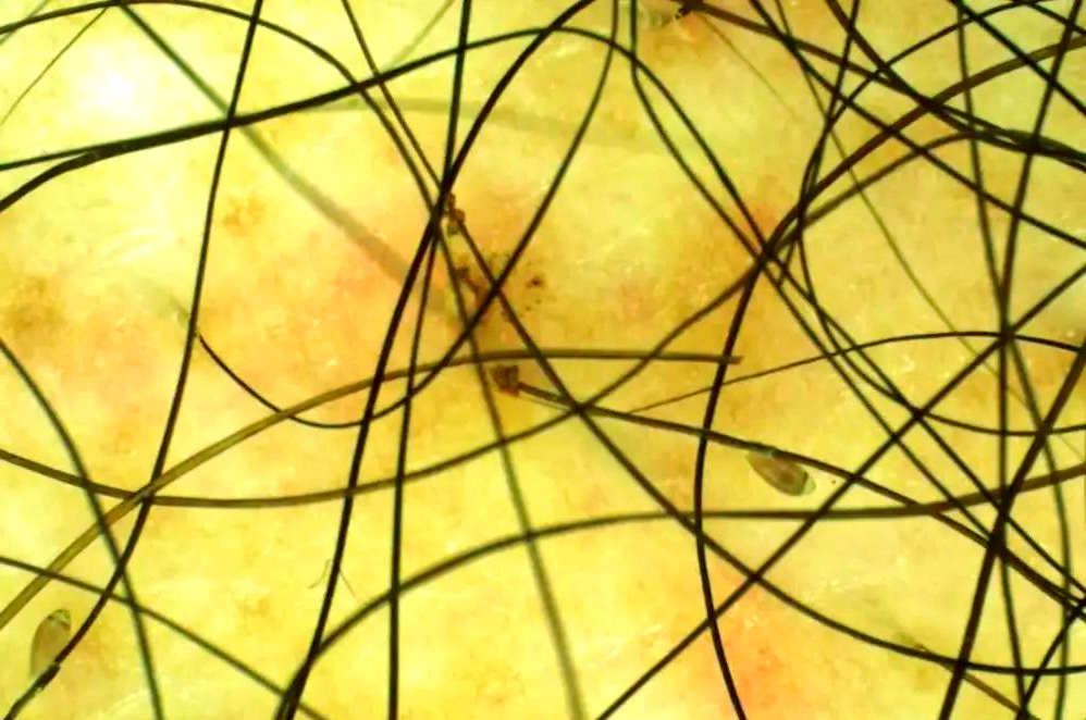 阴虱病详解:症状,传播途径与治疗方法