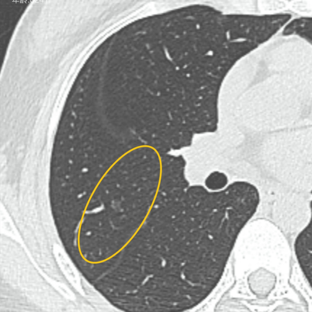 携女儿闽至渝求解7mm磨玻璃结节,精准诊断定"良"性保十年平安
