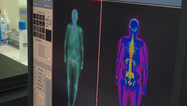碘131治疗,会不会影响身体其他器官?