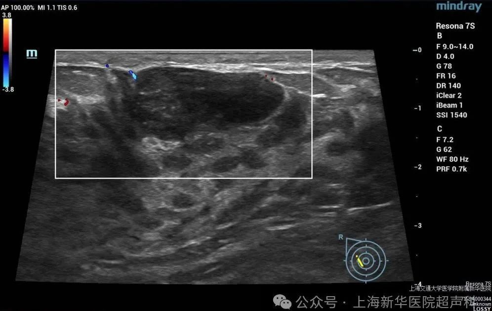 收藏贴 一文读懂乳腺超声