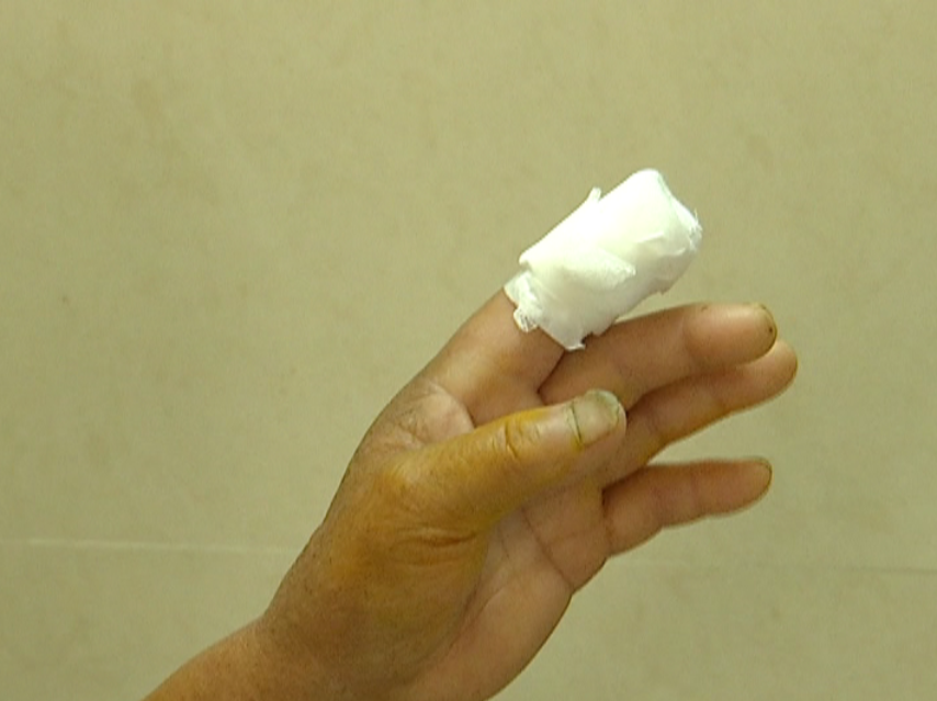 王大爷现在还在绍兴市中医院住院治疗,左手食指包着厚厚的纱布.