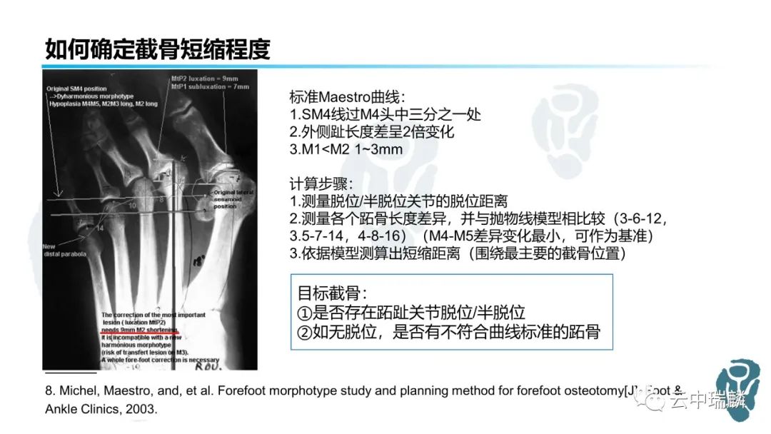 weil截骨术的临床应用