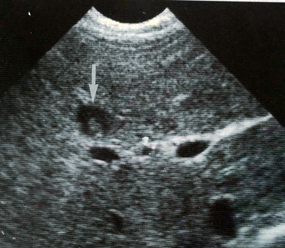 多种情况下的超声"牛眼征"表现