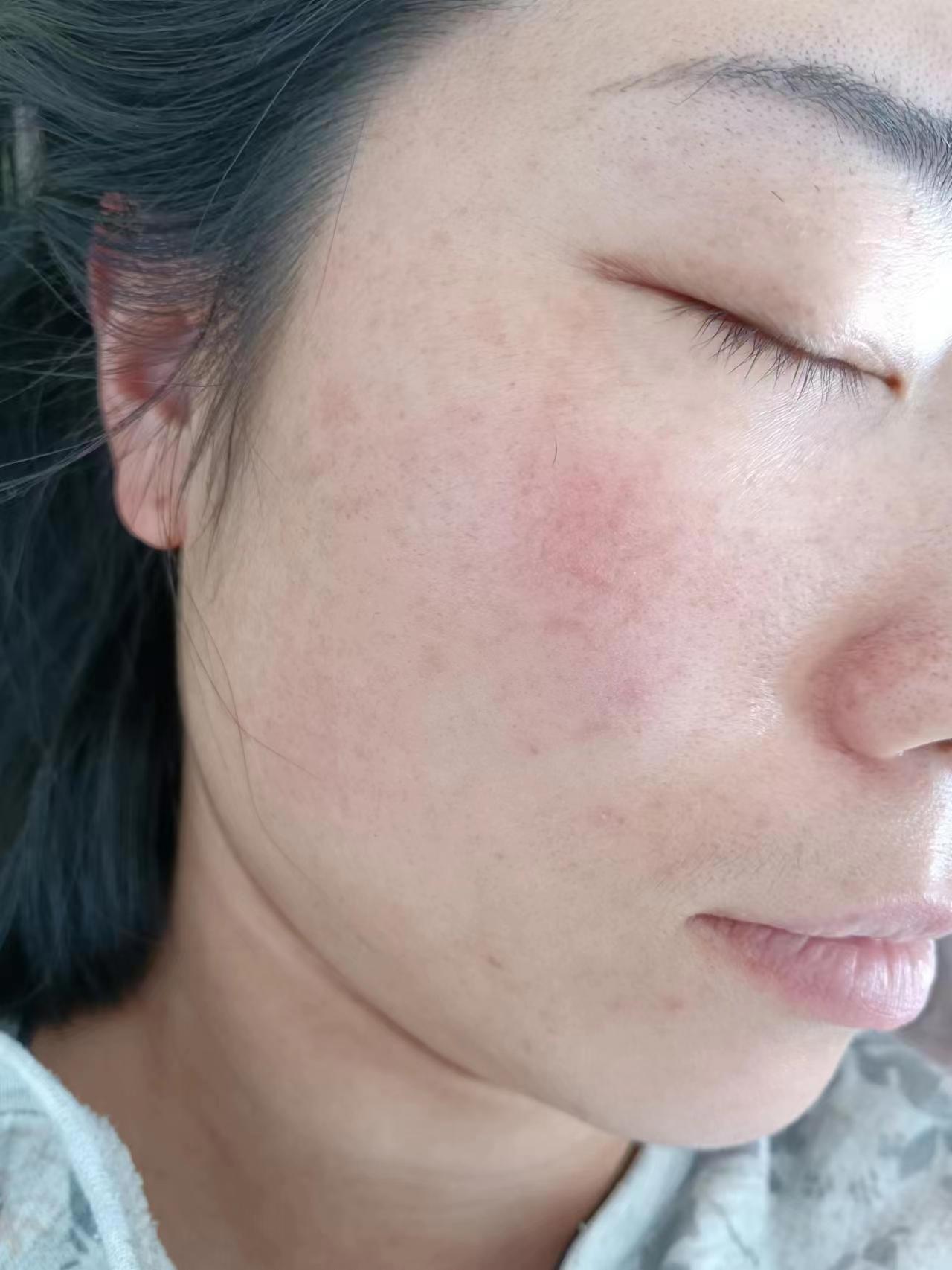 红色素沉着怎么去除?