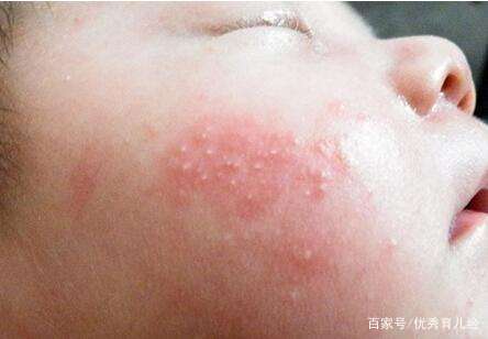 婴儿湿疹最佳治疗方法(婴儿湿疹最佳治疗方法桃子水)-第1张图片-鲸幼网