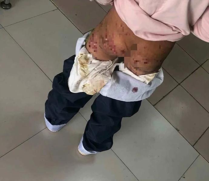 老师上课发现女孩衣服渗血……不敢相信这是亲妈干的事!