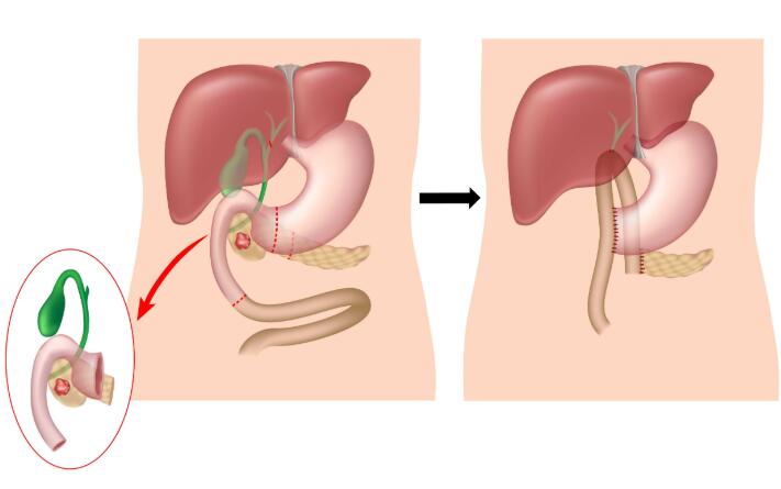 息肉是癌症的敲门砖?医生忠告:长在4个部位的息肉,需早做手术