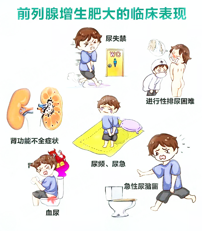 男性前列腺增生肥大有哪些临床表现?