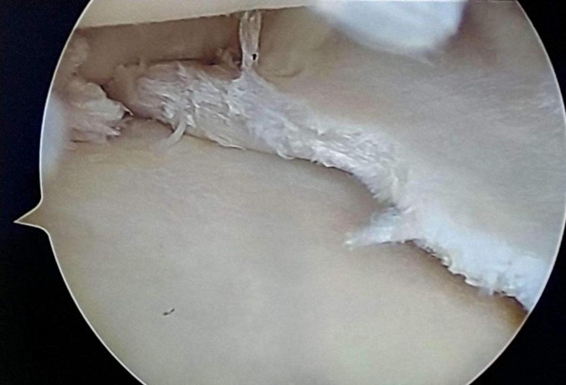 半月板损伤,作为最常见的膝关节损伤之一