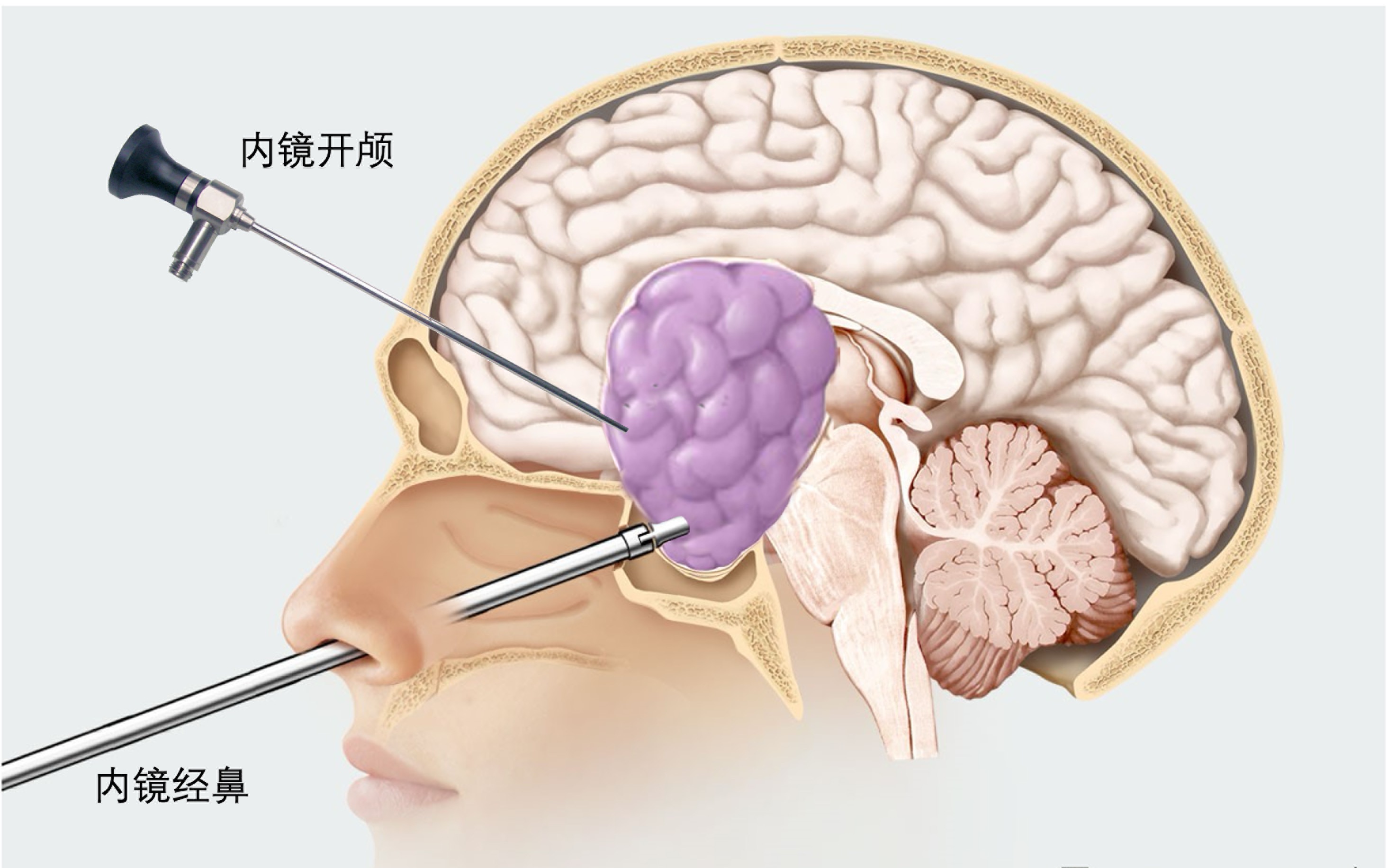 非常罕见!男子脑内长"巨无霸"垂体瘤,样貌发生了变化